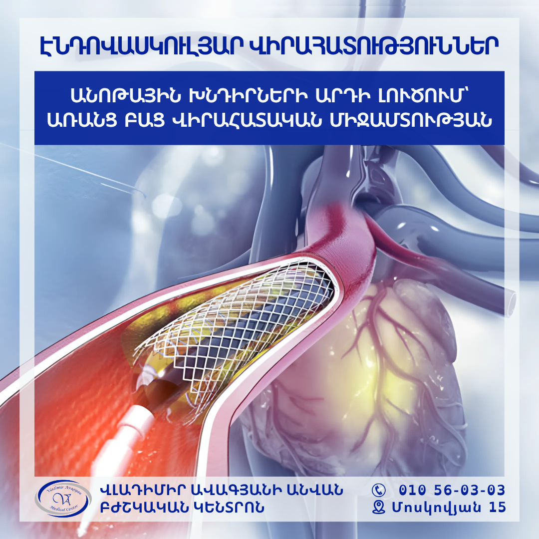 ԱՆՈԹԱՅԻՆ ԽՆԴԻՐՆԵՐԻ ԱՐԴԻ ԼՈՒԾՈՒՄԸ՝ ԱՌԱՆՑ ԲԱՑ ՎԻՐԱՀԱՏԱԿԱՆ ՄԻՋԱՄՏՈՒԹՅԱՆ